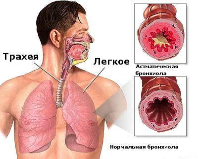 Симптомы бронхиальной астмы